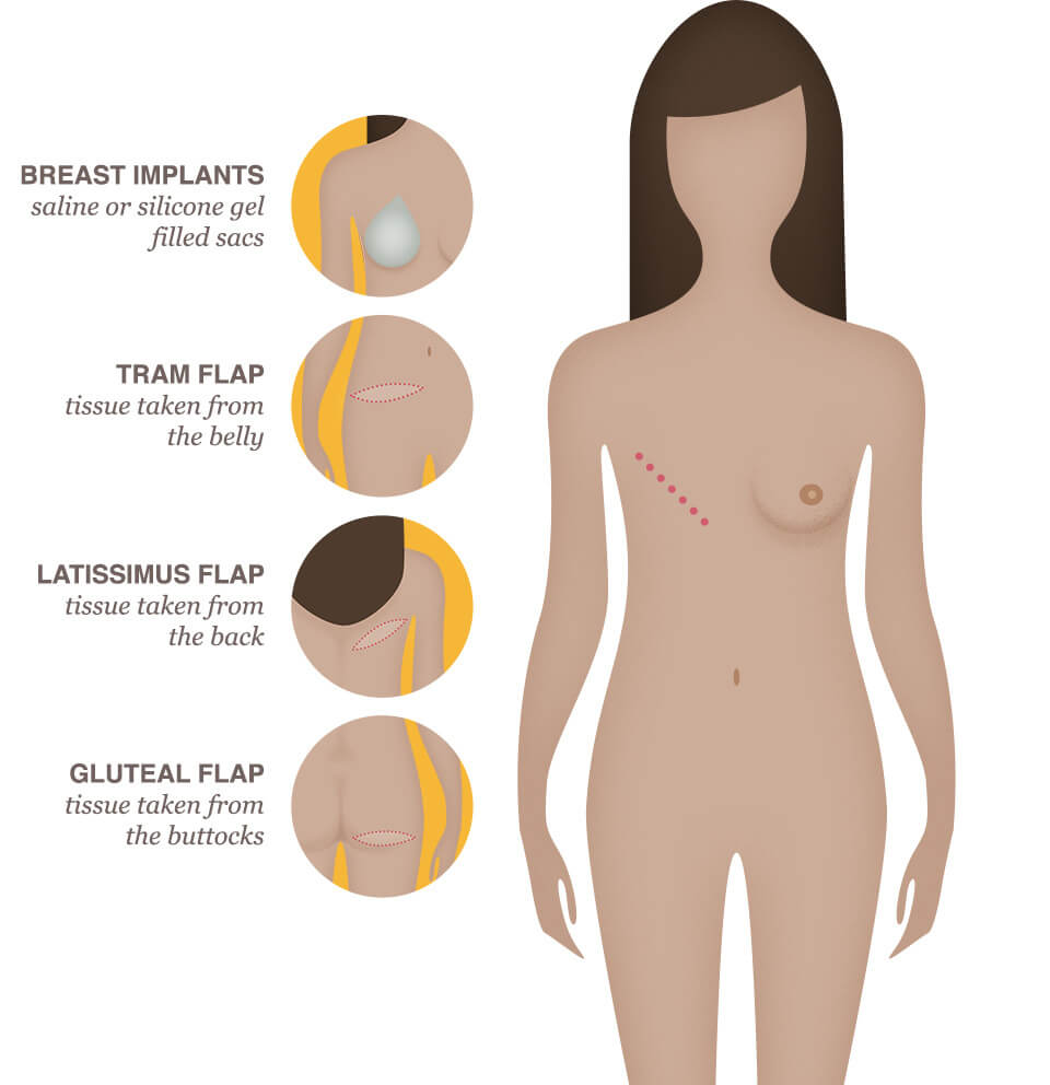 The different breast cancer types. Image extracted from