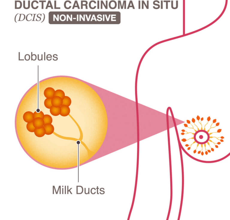 ductal-carcinoma-in-situ-dcis-national-breast-cancer-foundation