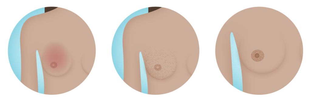 What does it mean when my breasts are always itchy and hurting