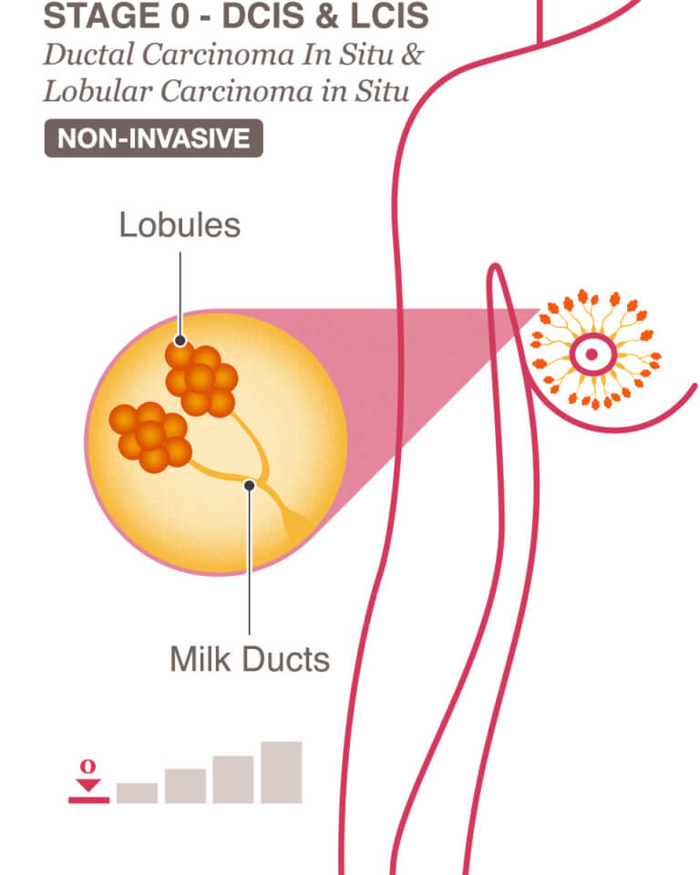 stages-0-1-breast-cancer-overview-national-breast-cancer-foundation