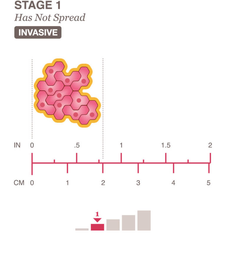 Stages 0 & 1 Breast Cancer Overview - National Breast Cancer Foundation