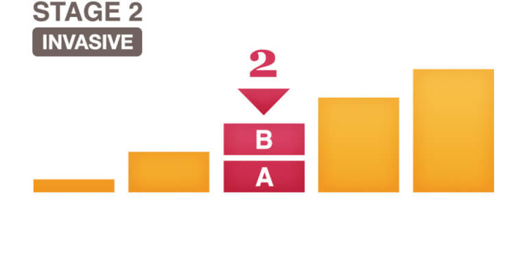 stage-2-ii-and-stage-2a-iia-breast-cancer-overview-national