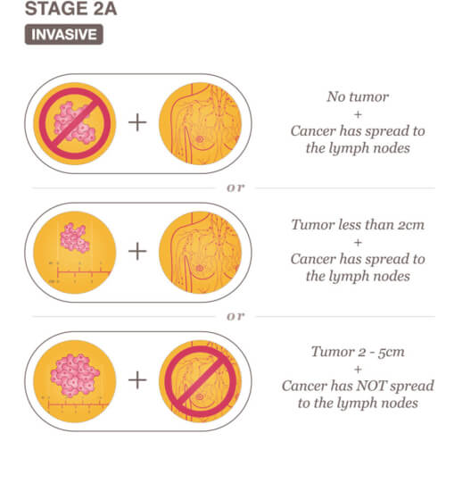 What Is Stage 2 Cancer