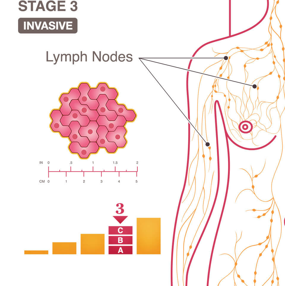 Stage 3 (III) A, B, And C Breast Cancer Overview - National Breast