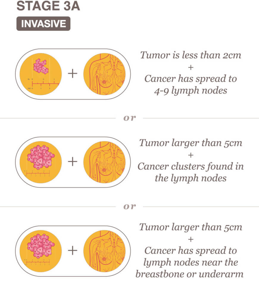 Stage 3 III A B And C Breast Cancer Overview National Breast 