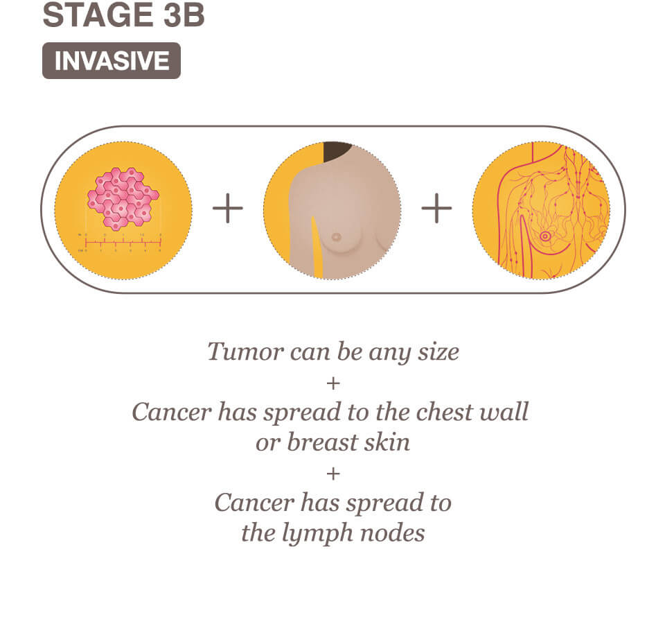 Breast Cancer Tumor Size Chart and Stage