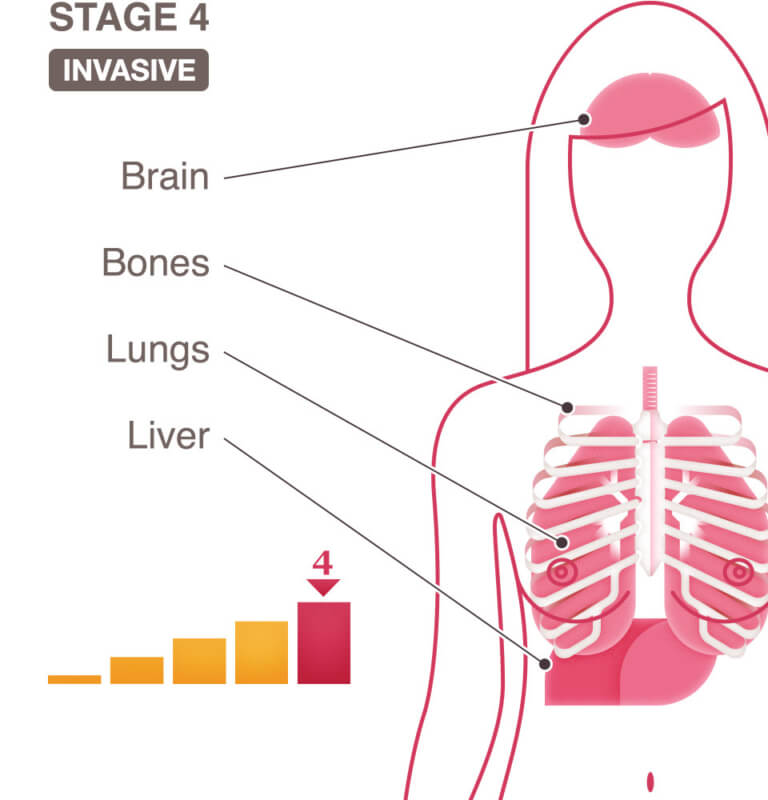 stage-4-iv-breast-cancer-national-breast-cancer-foundation