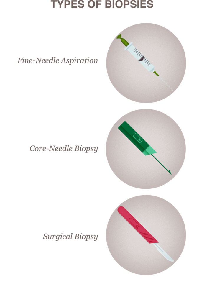 Open Breast Biopsy: Before Your Surgery