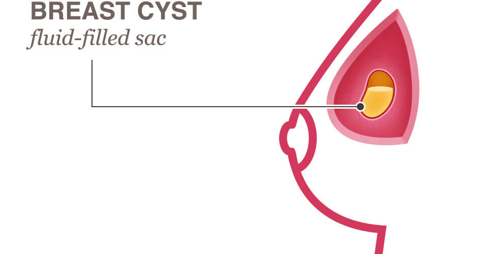 What Is A Breast Cyst 