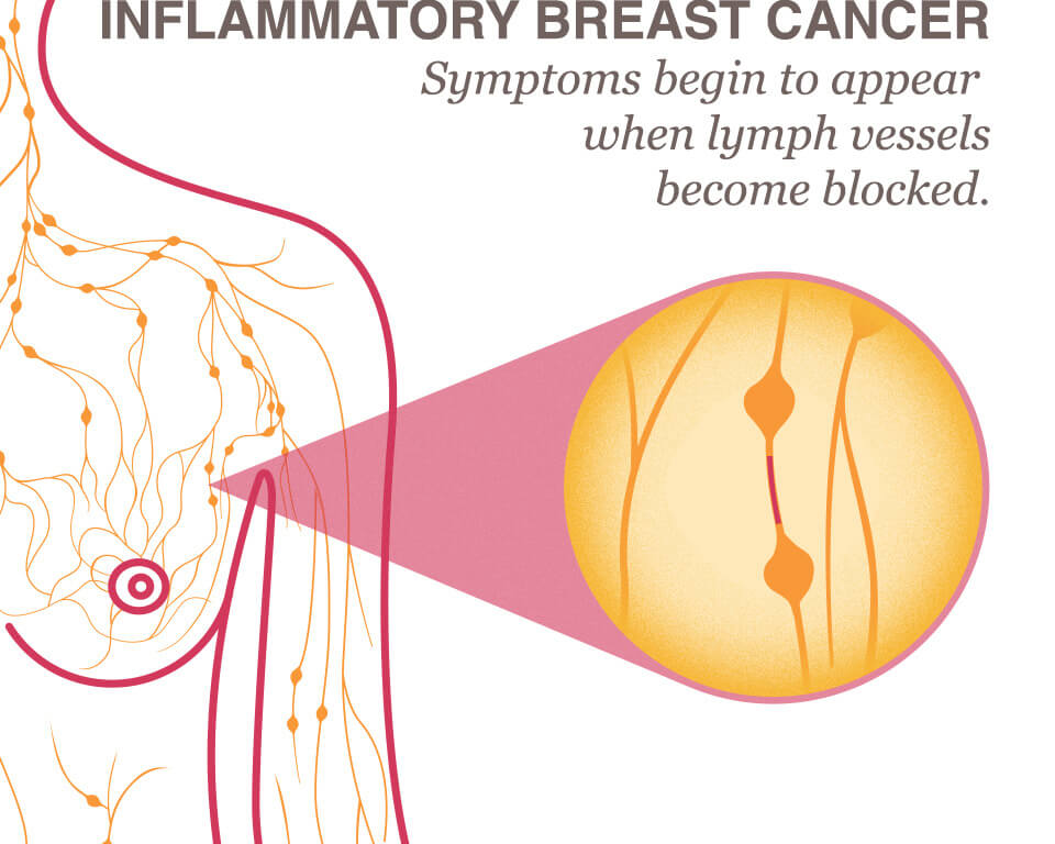 Inflammatory Breast Cancer: Symptoms, Diagnosis, Treatment